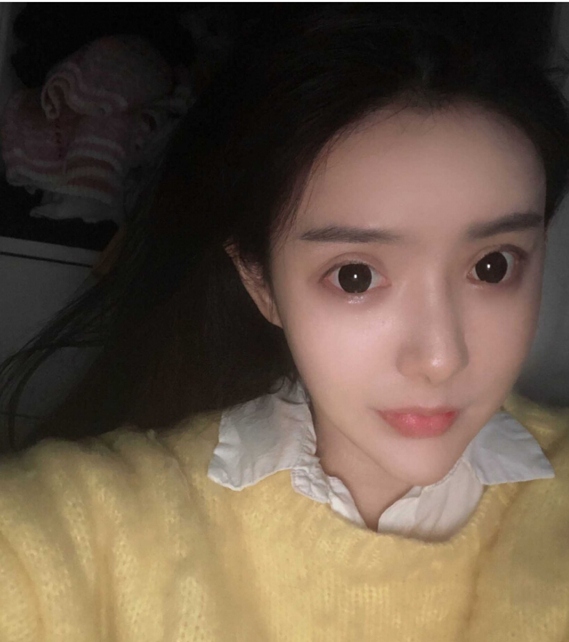 重慶柏漫醫(yī)療美容診所高紅艷醫(yī)生做面部吸脂怎么樣？面部吸脂案例分享