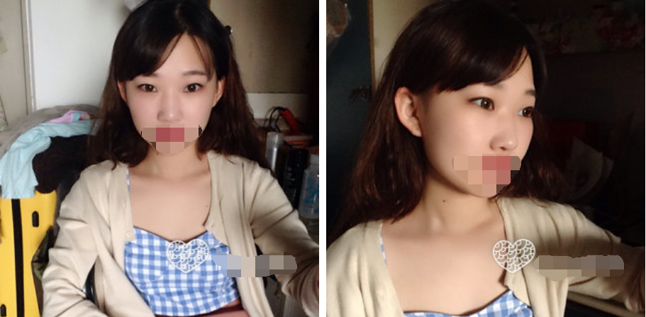 珠海艾瑞醫(yī)療美容醫(yī)院余昌盛醫(yī)生做耳軟骨隆鼻真實(shí)案例分享