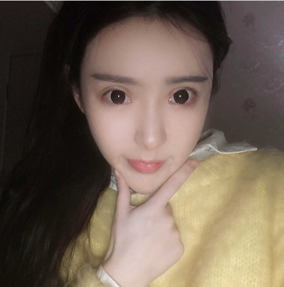 重慶柏漫醫(yī)療美容診所高紅艷醫(yī)生做面部吸脂怎么樣？面部吸脂案例分享