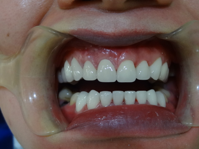 超聲波洗牙第二天效果