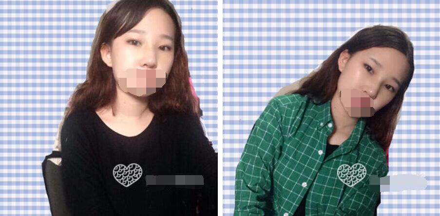 珠海艾瑞醫(yī)療美容醫(yī)院余昌盛醫(yī)生做耳軟骨隆鼻真實案例分享