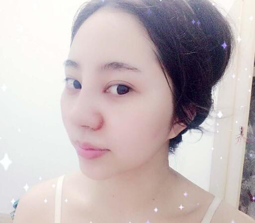 蘇州明基醫(yī)院醫(yī)療美容科做鼻綜合整形怎么樣？蘇州明基鼻綜合整形案例