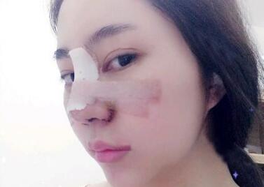 蘇州明基醫(yī)院醫(yī)療美容科做鼻綜合整形怎么樣？蘇州明基鼻綜合整形案例