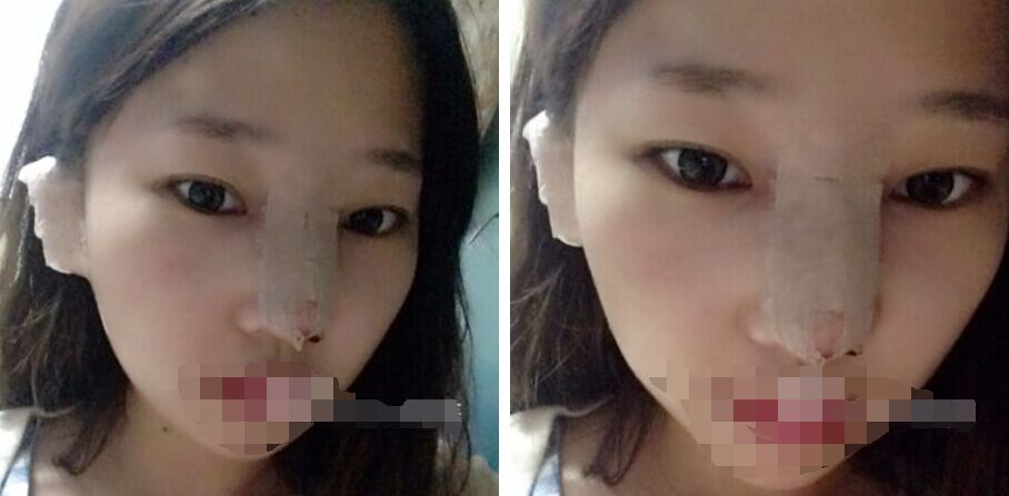 珠海艾瑞醫(yī)療美容醫(yī)院余昌盛醫(yī)生做耳軟骨隆鼻真實案例分享