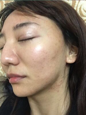 重慶柏漫醫(yī)療美容診所做激光祛痘效果怎么樣？白亞亞激光祛痘案例