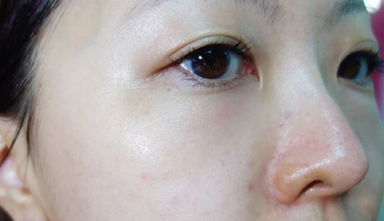 徐州時光洪揚醫(yī)療美容診所宮昔愿醫(yī)生做激光祛斑效果怎么樣？