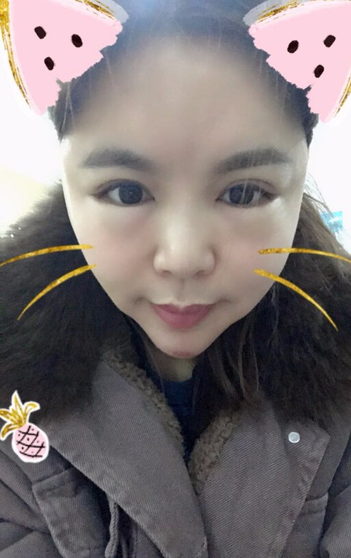 重慶聯(lián)合麗格美容醫(yī)院林麗蓉醫(yī)生做自體脂肪豐蘋果肌怎么樣？附案例