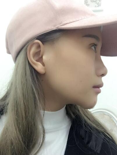 長春奧拉克美容醫(yī)院金相勛醫(yī)生做玻尿酸豐臥蠶怎么樣？附案例