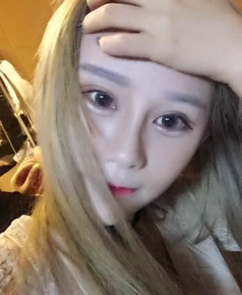 長春奧拉克美容醫(yī)院金相勛醫(yī)生做玻尿酸豐臥蠶怎么樣？附案例