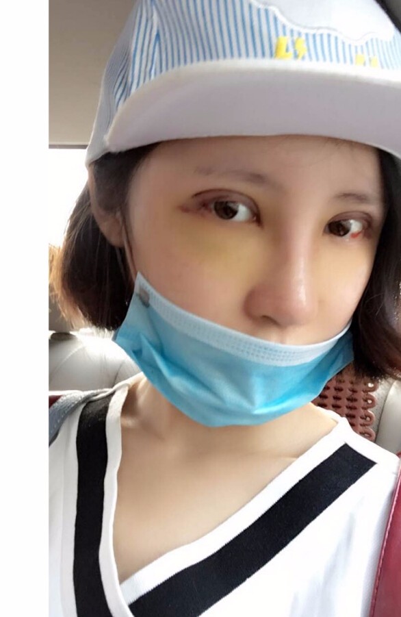 長沙愛思特整形醫(yī)院陳星光醫(yī)生做鼻部多項+自體脂肪隆鼻+切開雙眼皮+開外眼角案例 長沙愛思特整形醫(yī)院陳星光醫(yī)生做鼻部多項+自體脂肪隆鼻+切開雙眼皮+開外眼角案例