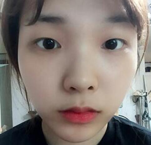 象山華美整形美容醫(yī)院趙誠(chéng)厚醫(yī)生做切開雙眼皮+開內(nèi)眼角整形案例 象山華美整形美容醫(yī)院趙誠(chéng)厚醫(yī)生做切開雙眼皮+開內(nèi)眼角整形案例