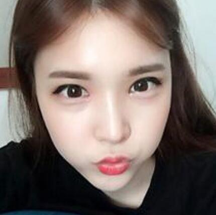 象山華美整形美容醫(yī)院趙誠(chéng)厚醫(yī)生做切開雙眼皮+開內(nèi)眼角整形案例 象山華美整形美容醫(yī)院趙誠(chéng)厚醫(yī)生做切開雙眼皮+開內(nèi)眼角整形案例