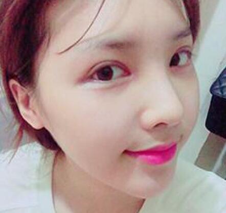 象山華美整形美容醫(yī)院趙誠(chéng)厚醫(yī)生做切開雙眼皮+開內(nèi)眼角整形案例 象山華美整形美容醫(yī)院趙誠(chéng)厚醫(yī)生做切開雙眼皮+開內(nèi)眼角整形案例