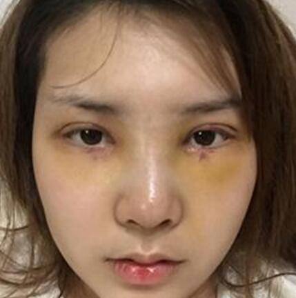 象山華美整形美容醫(yī)院趙誠(chéng)厚醫(yī)生做切開雙眼皮+開內(nèi)眼角整形案例 象山華美整形美容醫(yī)院趙誠(chéng)厚醫(yī)生做切開雙眼皮+開內(nèi)眼角整形案例