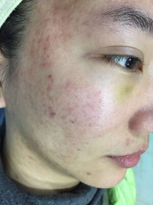 重慶柏漫醫(yī)療美容診所做激光祛痘效果怎么樣？白亞亞激光祛痘案例