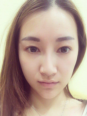 重慶五洲女子醫(yī)院整形美容中心做光子嫩膚怎么樣？淡明斌醫(yī)生光子嫩膚案例