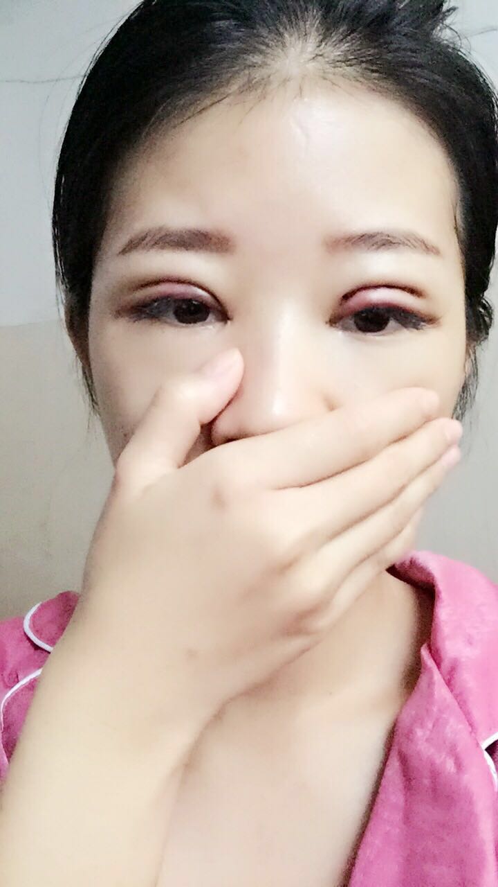 深圳晨曦醫(yī)療整形醫(yī)生吉米斯做切開雙眼皮怎么樣？吉米斯切開雙眼皮案例效果