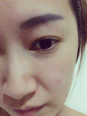 重慶五洲女子醫(yī)院整形美容中心做光子嫩膚怎么樣？淡明斌醫(yī)生光子嫩膚案例