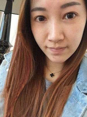 重慶五洲女子醫(yī)院整形美容中心做光子嫩膚怎么樣？淡明斌醫(yī)生光子嫩膚案例