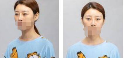 太原歐美蓮整形醫(yī)院丁曉峰醫(yī)生做雙眼皮怎么樣？丁曉峰雙眼皮手術案例分享