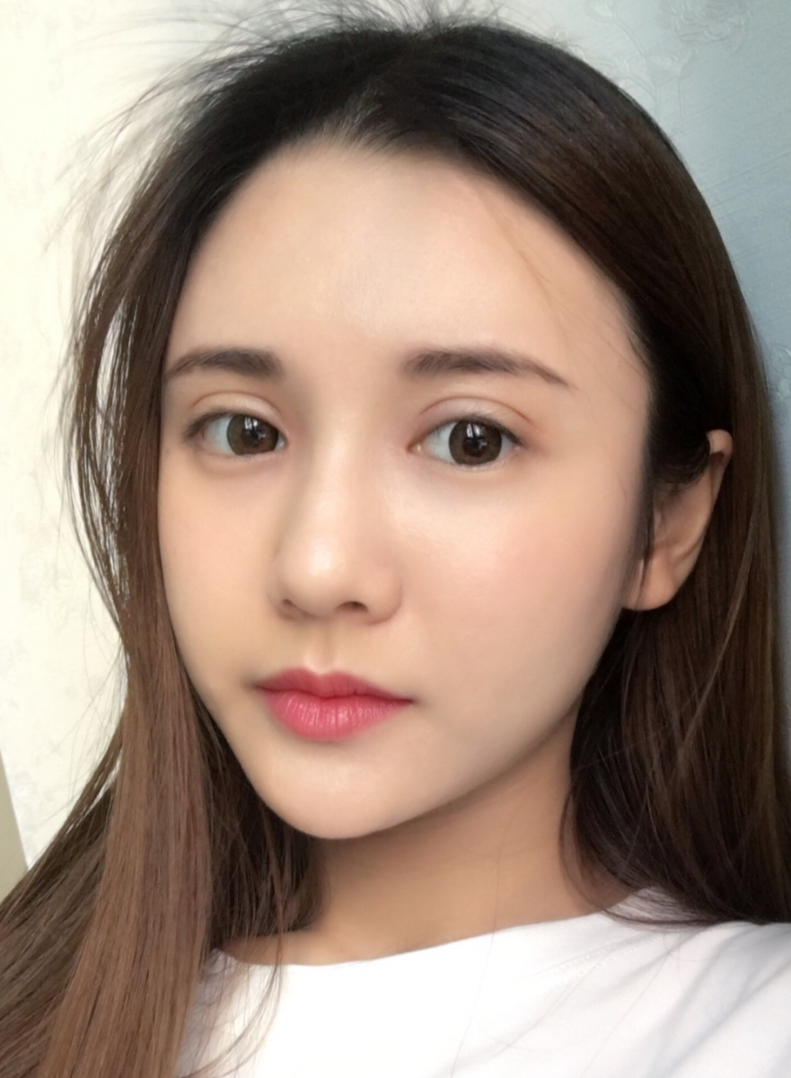 鄭州銘藝整形醫(yī)生陳濤做切開雙眼皮怎么樣？鄭州銘藝切開雙眼皮案例