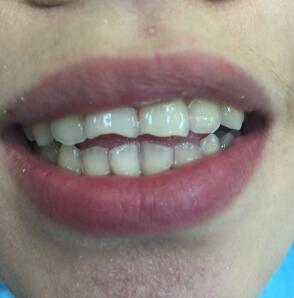 武漢康承貝健口腔醫(yī)院宋磊醫(yī)生做二氧化鋯全瓷牙效果怎么樣？附案例