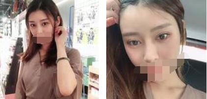 太原歐美蓮整形醫(yī)院丁曉峰醫(yī)生做雙眼皮怎么樣？丁曉峰雙眼皮手術案例分享