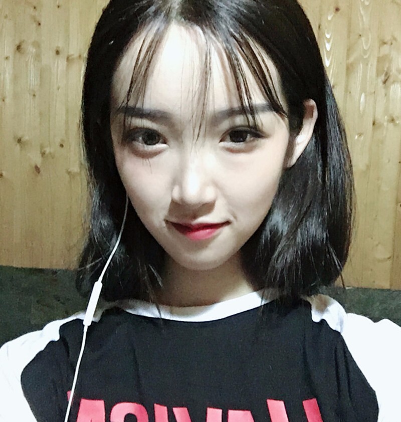 重慶威妮醫(yī)療整形醫(yī)生伊莉做切開雙眼皮+開眼角真人案例效果對比圖