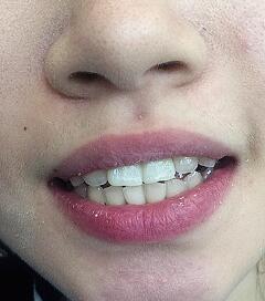 武漢康承貝健口腔醫(yī)院宋磊醫(yī)生做二氧化鋯全瓷牙效果怎么樣？附案例