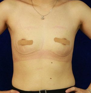 珠海萊茵醫(yī)療美容醫(yī)院崔俊溶醫(yī)生做自體脂肪隆胸效果怎么樣？附自體脂肪隆胸案例