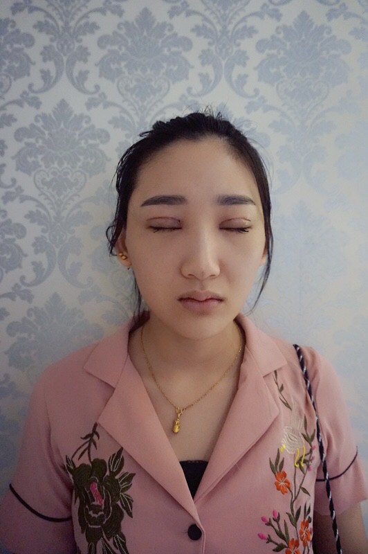 武漢中翰整形外科醫(yī)院沈磊醫(yī)生做切開雙眼皮怎么樣？附沈磊切開雙眼皮案例