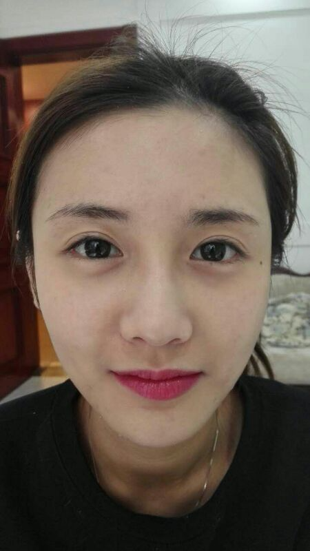 鄭州銘藝整形醫(yī)生陳濤做切開雙眼皮怎么樣？鄭州銘藝切開雙眼皮案例