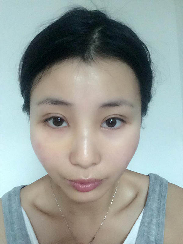 桂林新華醫(yī)療美容醫(yī)生李新華做雙眼皮手術(shù)怎么樣？李新華雙眼皮手術(shù)案例