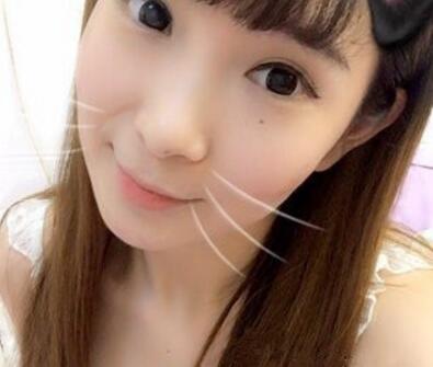 武漢中翰整形外科醫(yī)院陳志鵬醫(yī)生做雙眼皮修復效果怎么樣？附雙眼皮修復案例