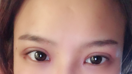 長春麥西美嘉整形醫(yī)生王圣博做雙眼皮手術(shù)效果怎么樣？附雙眼皮案例