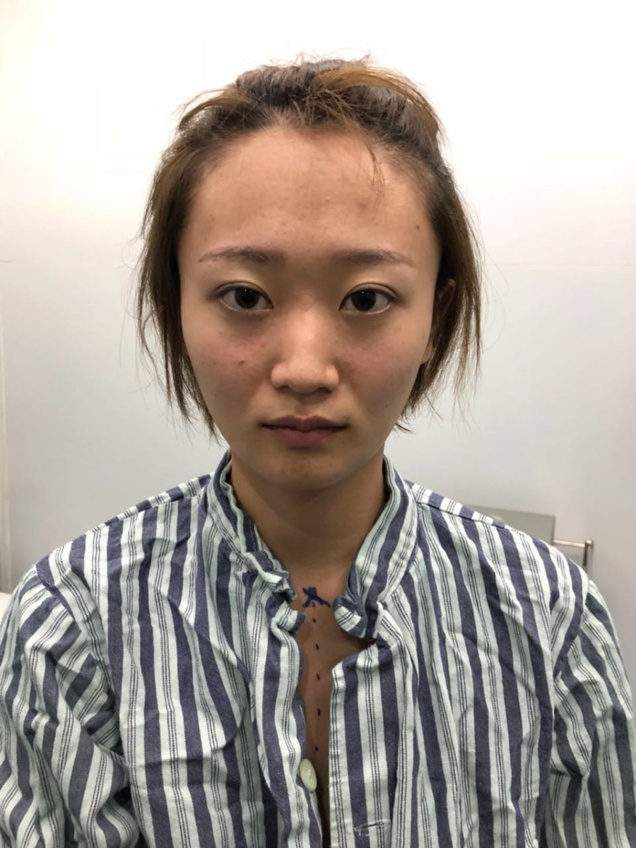 杭州迪美整形常德成醫(yī)生做鼻綜合整形技術(shù)怎么樣？附鼻綜合整形案例