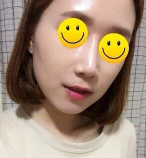 信陽東方藝美容醫(yī)院劉力萌做玻尿酸去法令紋效果怎么樣？附案例效果對比圖