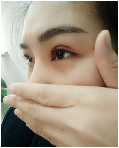 營(yíng)口臻美醫(yī)療整形醫(yī)生閆迎軍做雙眼皮效果怎么樣？附雙眼皮案例對(duì)比圖