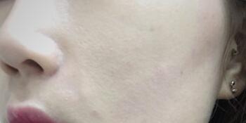 信陽(yáng)東方藝美容醫(yī)院劉力萌做玻尿酸去法令紋效果怎么樣？附案例效果對(duì)比圖