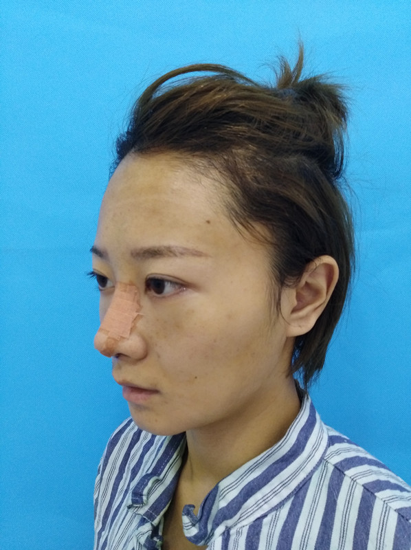 杭州迪美整形常德成醫(yī)生做鼻綜合整形技術(shù)怎么樣？附鼻綜合整形案例