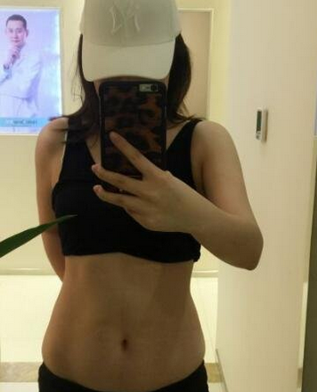 成都蜀尚蓉雅整形醫(yī)生張知華做腰腹吸脂效果怎么樣？附腰腹吸脂案例