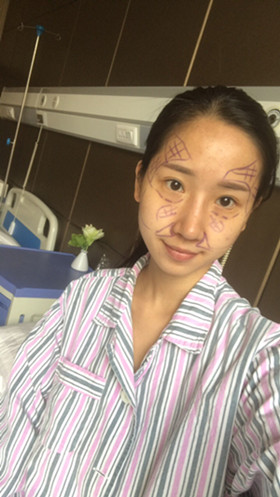 湛江澳泰整形醫(yī)院彭鑫醫(yī)生做自體脂肪豐蘋果肌+太陽穴案例效果對比圖