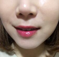 信陽(yáng)東方藝美容醫(yī)院劉力萌做玻尿酸去法令紋效果怎么樣？附案例效果對(duì)比圖