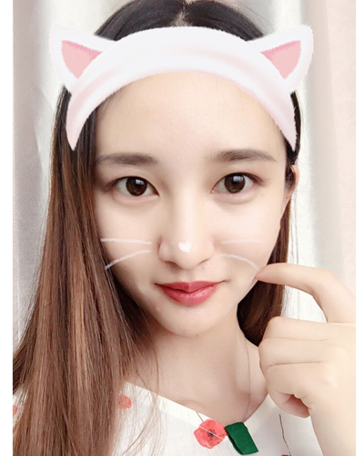 武漢維納斯整形醫(yī)院趙瑾醫(yī)生做玻尿酸墊下巴怎么樣？附玻尿酸墊下巴案例