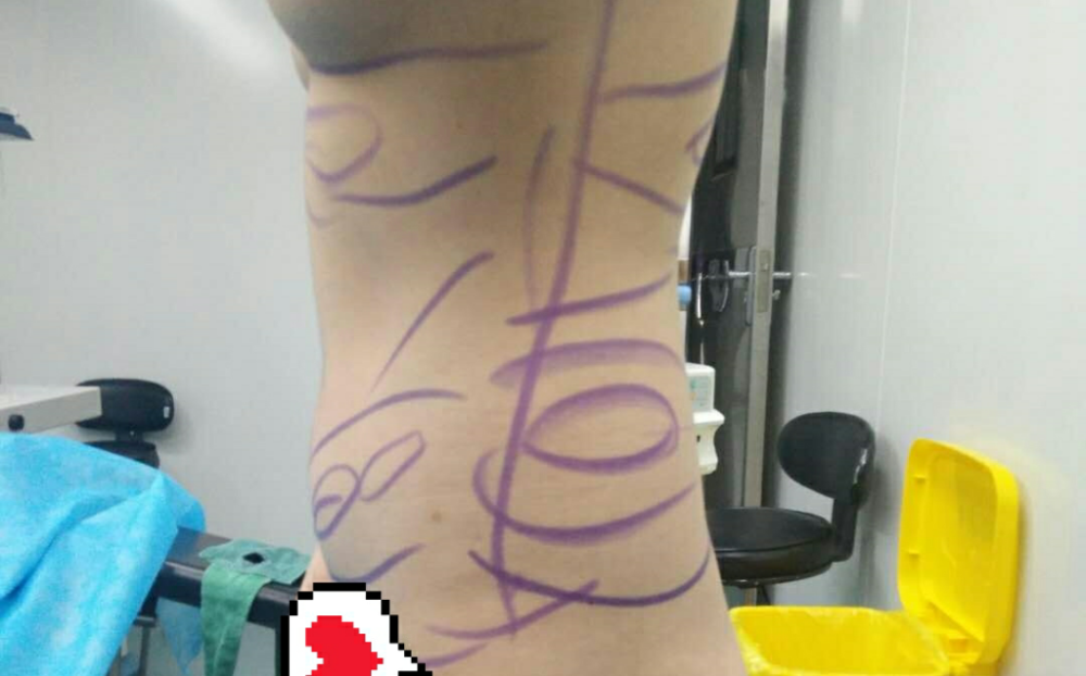 沈陽(yáng)天使醫(yī)療整形醫(yī)生黃展翼做水動(dòng)力腰腹吸脂技術(shù)怎么樣？附水動(dòng)力腰腹吸脂案例