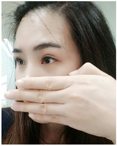 營(yíng)口臻美醫(yī)療整形醫(yī)生閆迎軍做雙眼皮效果怎么樣？附雙眼皮案例對(duì)比圖