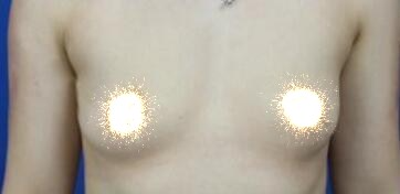 慈溪悅爾整形醫(yī)院趙天宇做自體脂肪隆胸怎么樣？附自體脂肪隆胸案例