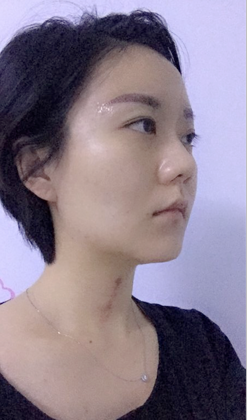 沈陽友誼整形美容醫(yī)院金顕哲醫(yī)生做自體脂肪填充臉部+V-LINE瓜子臉手術(shù)案例效果圖 沈陽友誼整形美容醫(yī)院金顕哲醫(yī)生做自體脂肪填充臉部+V-LINE瓜子臉手術(shù)案例效果圖