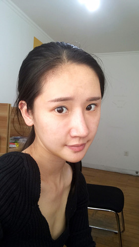 湛江澳泰整形醫(yī)院彭鑫醫(yī)生做自體脂肪豐蘋果肌+太陽(yáng)穴案例效果對(duì)比圖 湛江澳泰整形醫(yī)院彭鑫醫(yī)生做自體脂肪豐蘋果肌+太陽(yáng)穴案例效果對(duì)比圖