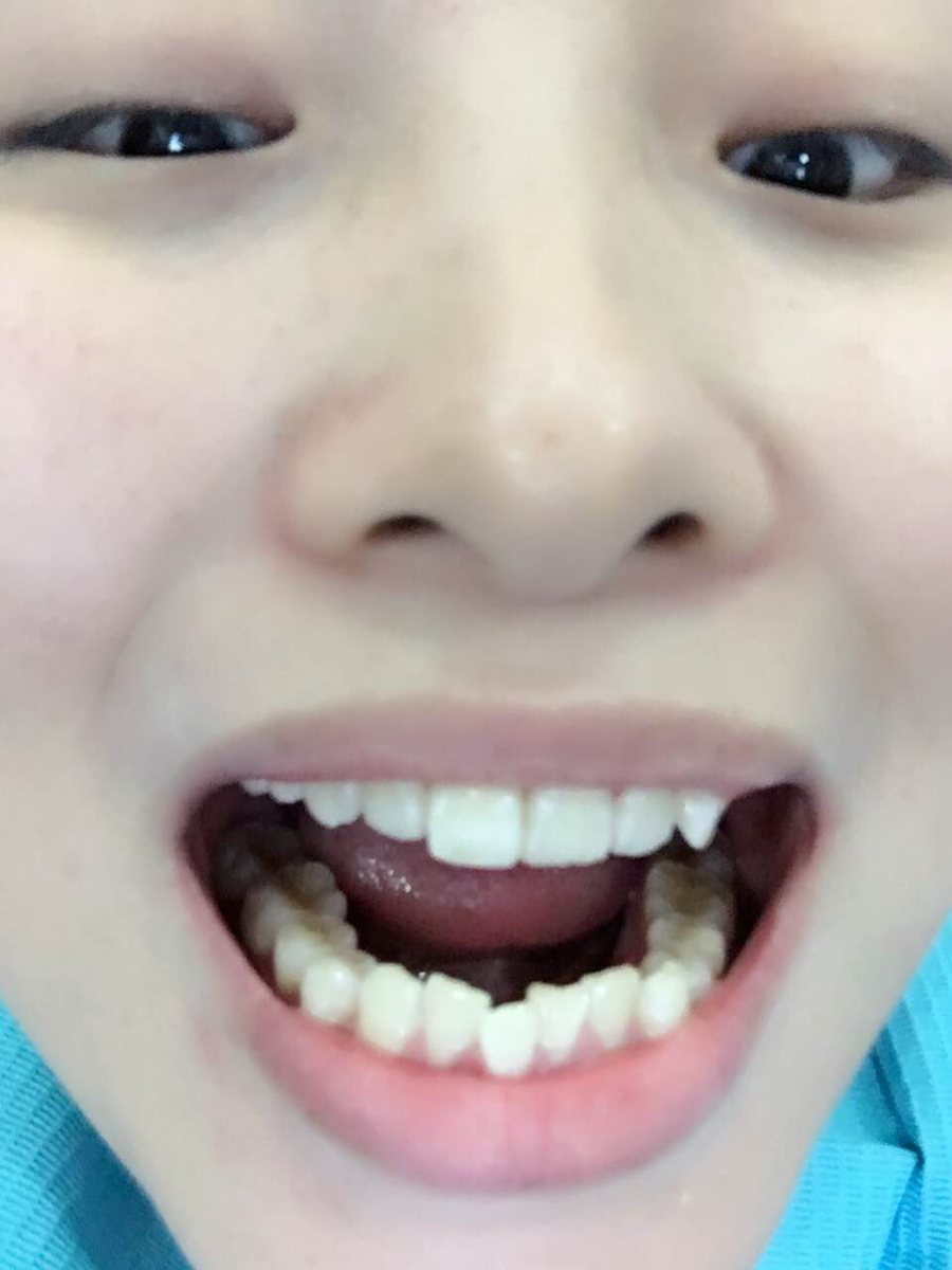 鄭州壹加壹整形醫(yī)院楊永利醫(yī)生做牙齒隱形矯正怎么樣？附牙齒隱形矯正案例